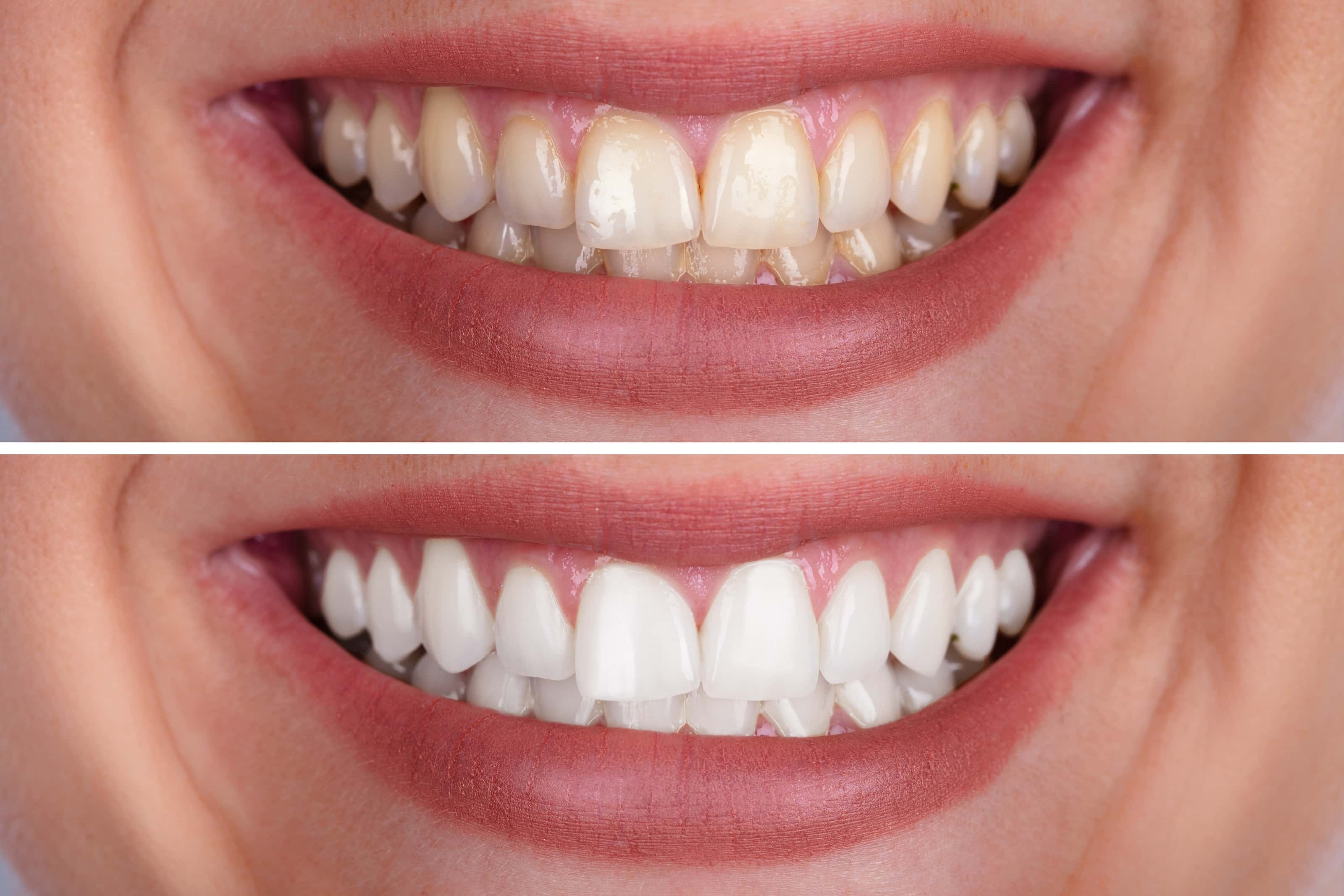 Long Island City Teeth Whitening BORO Dental Arts